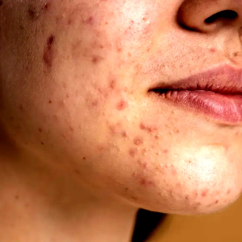 Tratamento de acne e cicatrizes