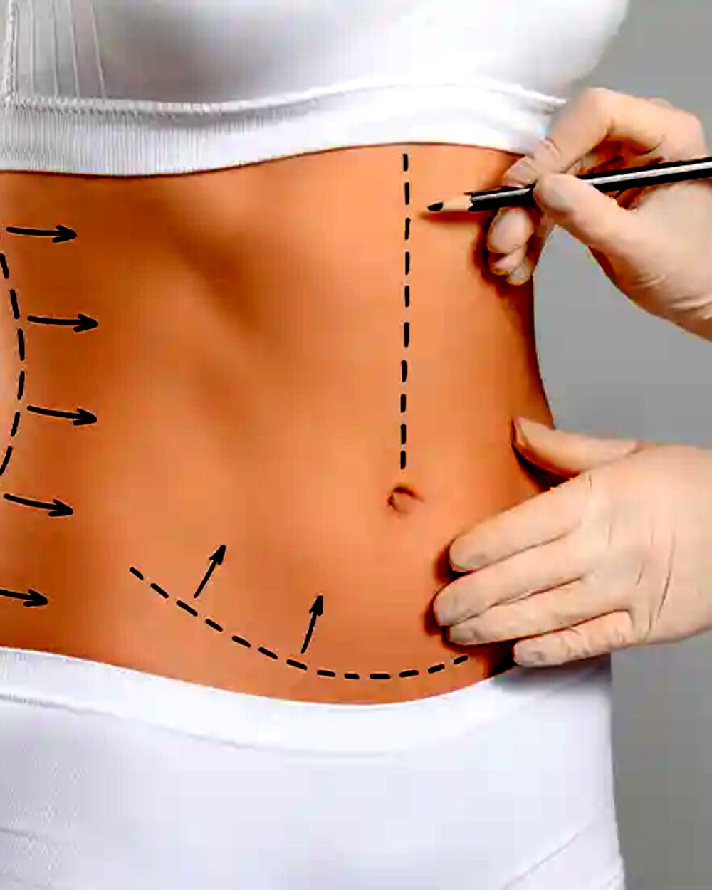 Abdominoplastia