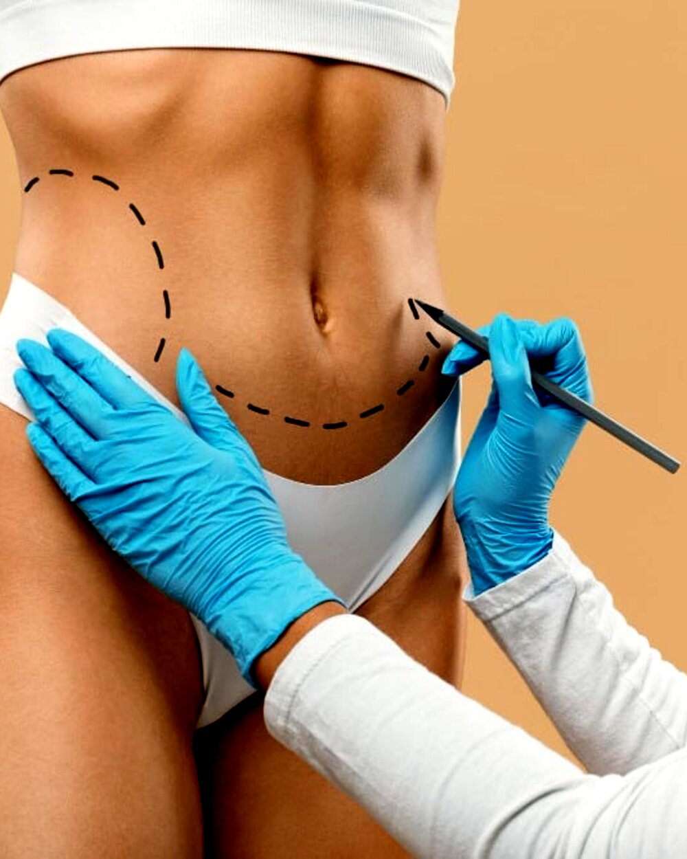Lipoaspiração